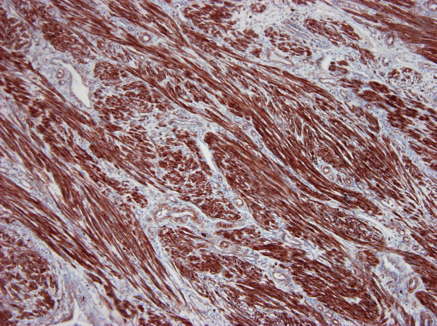 Figure 1. Formalin fixed, paraffin embedded human myoma tissue immunostained for beta cytoplasmic actin using MUB0110P (clone 4C2) at a 100x dilution. Note the strong staining of smooth muscle tissue.